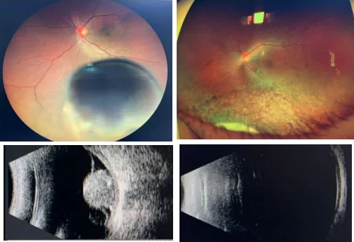 脈絡(luò)膜黑色素瘤